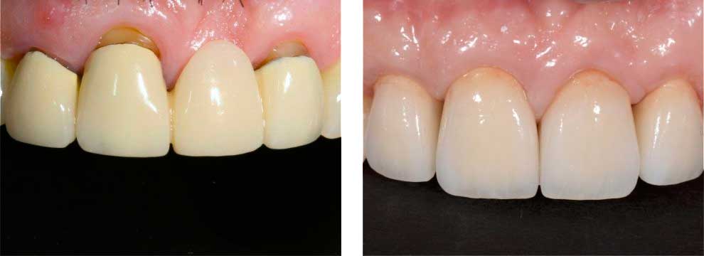 Two Natural Teeth
