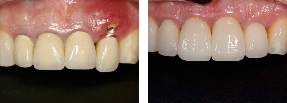 Implant