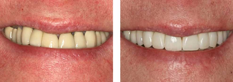 Full Mouth Reconstruction