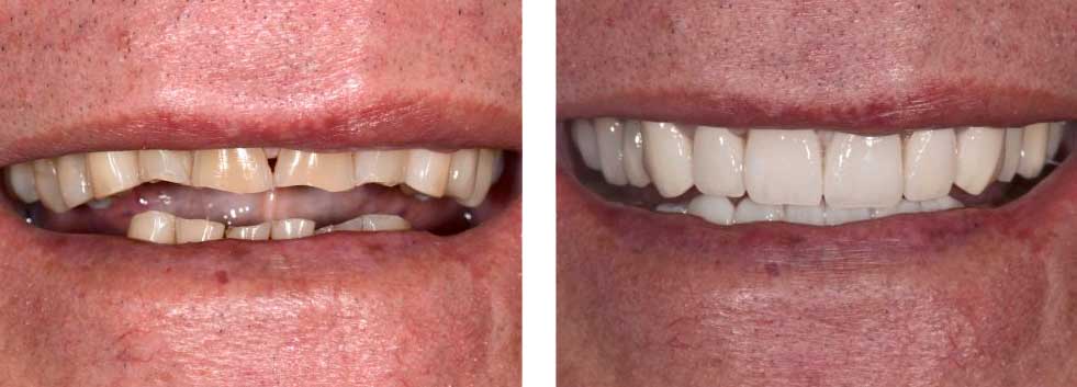 Full Mouth Reconstruction All Lower Implants