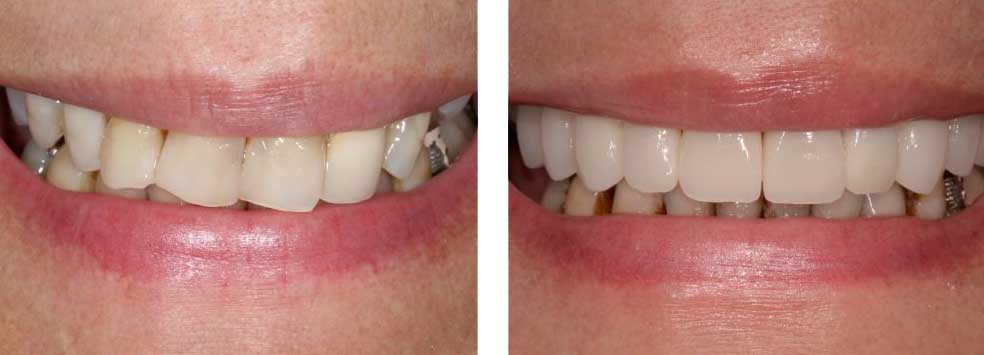 Full Mouth Reconstruction Smile Design