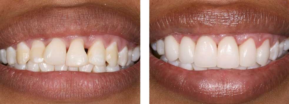 Anterior Cosmetic Veneers