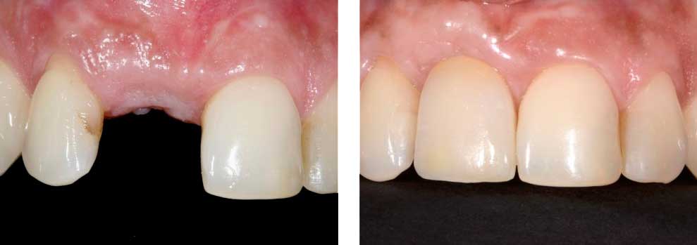 Crown Over Implant