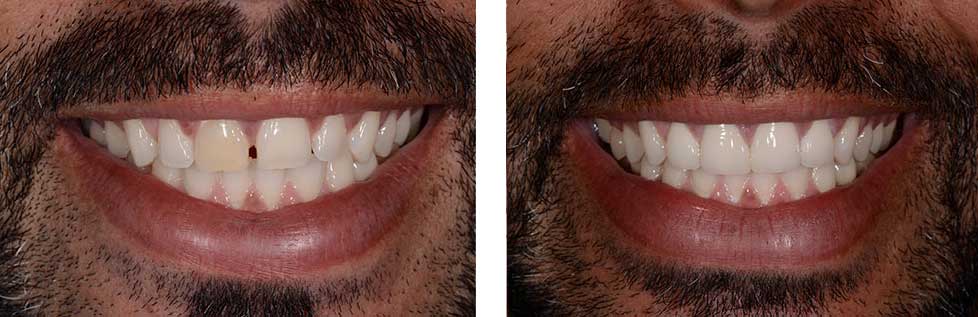 Smile Design