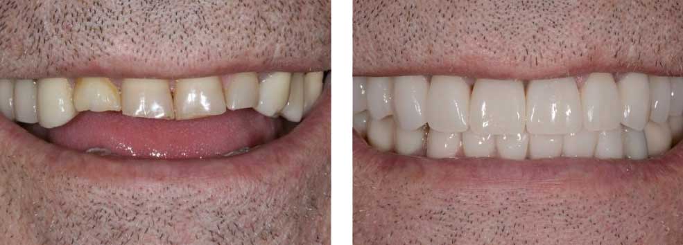 Full Mouth Reconstruction
