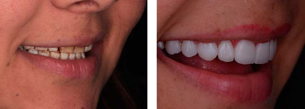 Full Mouth Esthetic Reconstruction Veneers