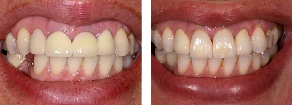 Crown Lengthening, Implant and Porcelain Crowns