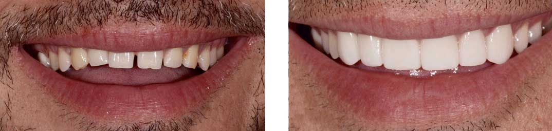 Dental Veneers Canine to Canine