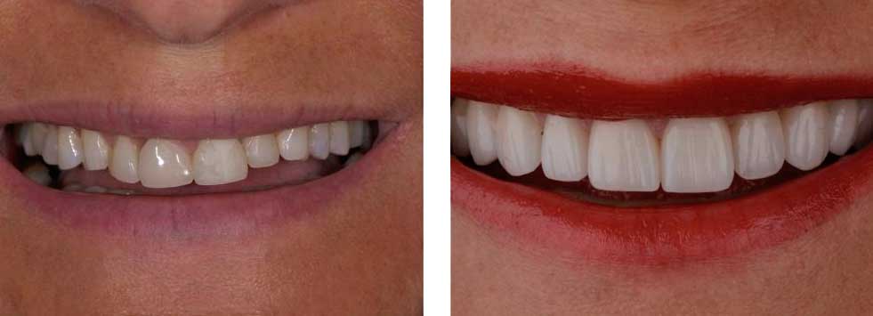 Smile Design Veneers