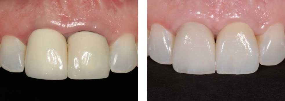 Anterior Crowns (One Over Implant)
