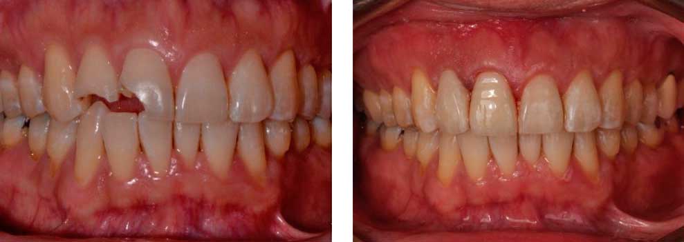 Full Contour Cosmetic Crowns