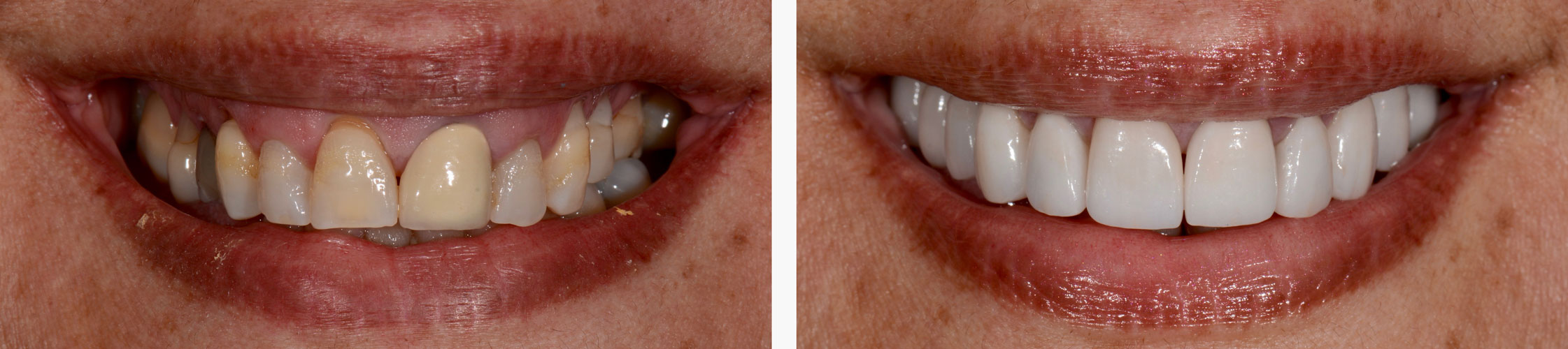 Smile Design & Crown Lengthening