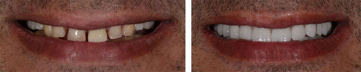 Full mouth rehabilitation