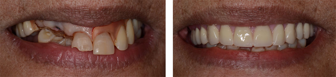 Hybrid immediate Temporary Prosthesis
