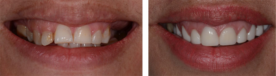Crown lengthening Full mouth reconstruction