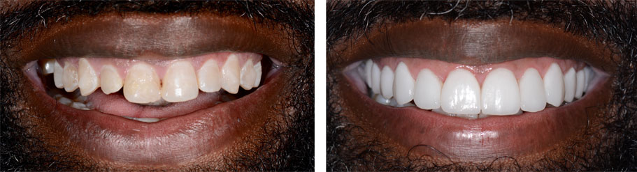 Veneers  smile design