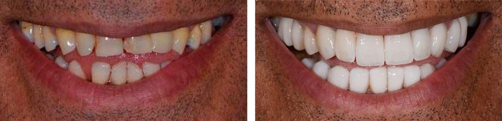 Full Esthetic Reconstruction